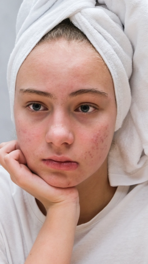 A sad teenage girl is looking at the pimples on her face in the mirror. Problematic skin in adolescents. Acne.